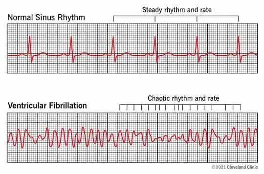 Normal sinus rhythm (NSR) vs Ventricular fibrillation (VF)
