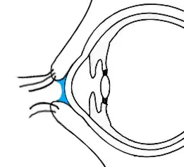 concave lens due to curved water surface