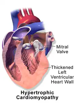 Hypertrophic cardiomyopathy.