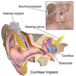 Cochlear implant.