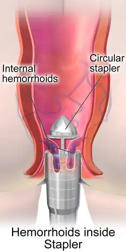 Stapled hemorrhoidopexy.