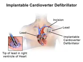 Implantable cardioverter-defibrillator.