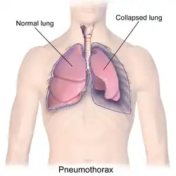 Pneumothorax.