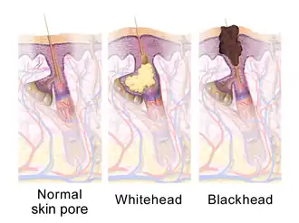 Sebaceous gland states.