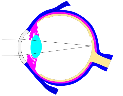 The previous image was downloaded, edited and resubmitted a dilated pupil.  Diagrams like this could be used to better understand why night driving is difficult for people who are nearsighted. This sketch ignores the bending of light by the eye lens because we have not ascertained a typical focal length for that lens.  The student who figures this out gets to post the corrected version.